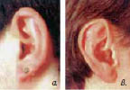Εικ. 5.15 Οι λοβοί των αυτιών μπορεί να είναι προσκολλημένοι (α) ή ελεύθεροι (β).