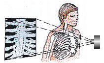 2-24 Ακτινογραφία. Τα οστά απορρίψουν εντονότερα τις ακτίνες Χ σε σύγκριση με τον υπόλοιπο ιστό. Έτσι στο φιλμ εμφανίζονται ως φωτεινότερες περιοχές.