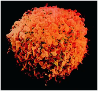 Eικόνα 1.35: Βοηθητικό Τ-λεμφοκύτταρο μολυσμένο με τον ιό του ΑΙDS (σε πράσινο χρώμα)