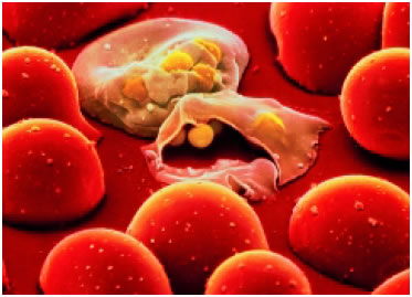 Εικόνα 1.3: Ερυθροκύτταρα που έχουν προσβληθεί από πλασμώδιο.