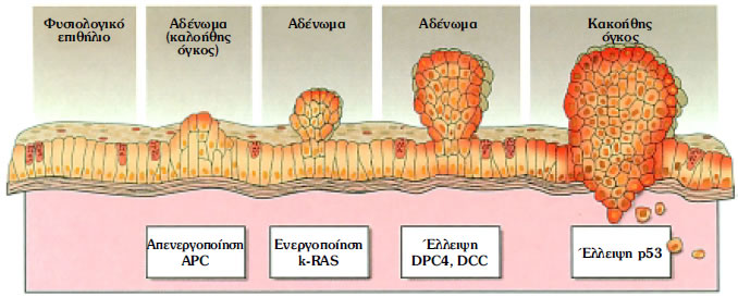 Εικόνα 1.40: Γονιδιακές μεταλλάξεις στον καρκίνο του παχέος εντέρου (k-RAS: ογκογονίδιο. APC, DCC, p53: ογκοκατασταλτικά γονίδια)
