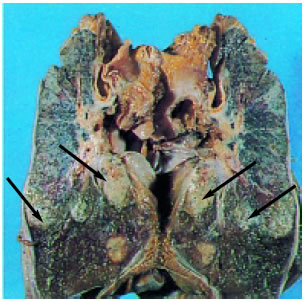Εικόνα 1.41: Καρκίνος του πνεύμονα. Τα βέλη δείχνουν τους κακοήθεις όγκους.