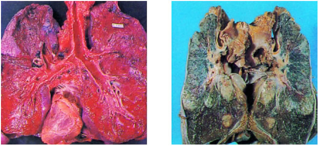 Εικόνα 1.47: Πνεύμονας ατόμου που δεν καπνίζει (αριστερά) και ατόμου που καπνίζει (δεξιά).