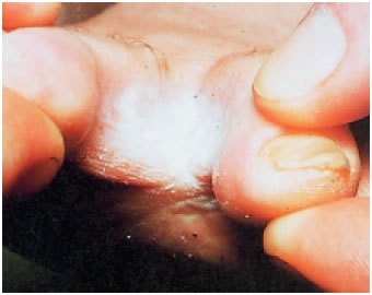 Εικόνα 1.4: Μυκητίαση ανάμεσα στα δάχτυλα των ποδιών