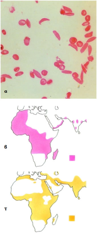 Εικόνα 3.30: α) Δρεπανοειδή ερυθρά αιμοσφαίρια, β) κατανομή αλληλόμορφου δρεπανοκυτταρικής αναιμίας (βs), γ) κατανομή ελονοσίας
